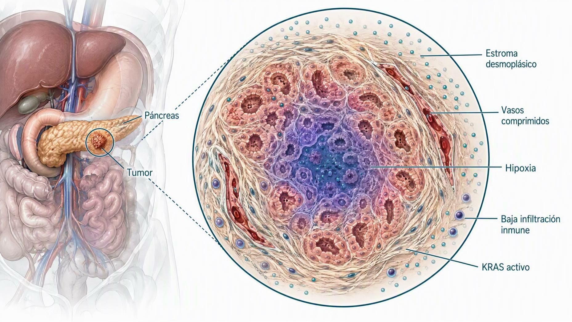 Tumor de páncreas rodeado de su coraza fibrosa